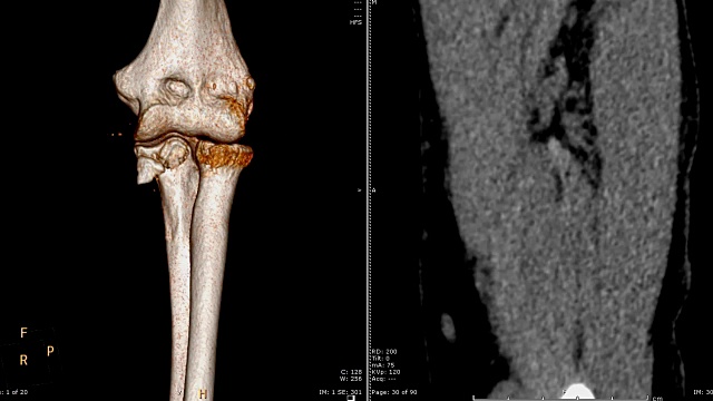 CT扫描仪右肘二维、三维图像渲染。视频素材