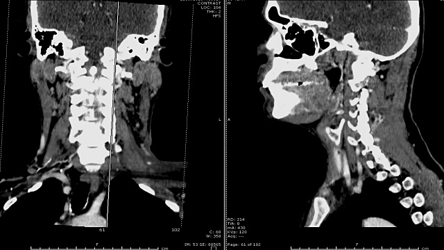颈部CT扫描。视频素材