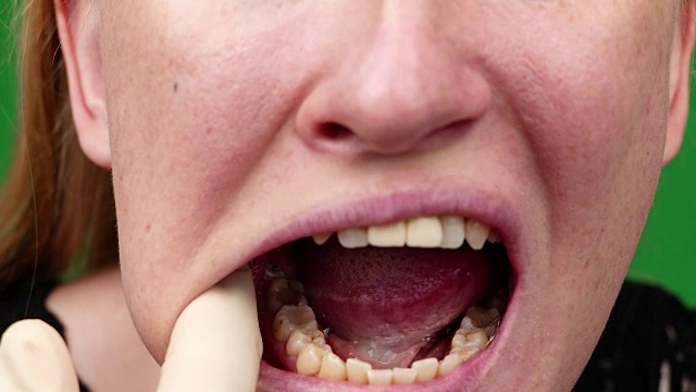 黄色牙齿的微距视频。这是一颗蛀牙的特写。口腔护理观念差。腐烂，难闻的气味，龋齿。嘴巴的闭合视频素材