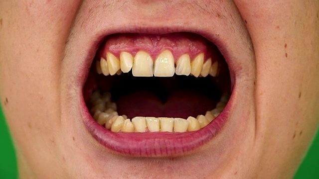 黄色牙齿的微距视频。这是一颗蛀牙的特写。口腔护理观念差。腐烂，难闻的气味，龋齿。嘴巴的闭合视频素材