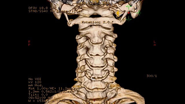 颈椎CT扫描。视频素材