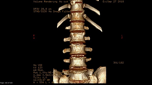 腰椎CT扫描图像三维渲染。视频素材