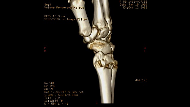 Ct扫描手腕关节三维渲染图像和二维冠状面和矢状面。视频素材