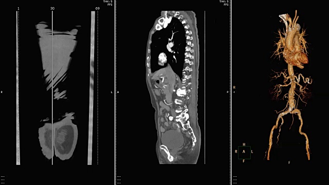 CTA腹主动脉。视频素材