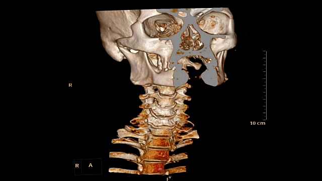 颈椎CT扫描。视频素材