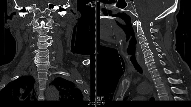 颈椎(颈椎)的CT扫描视频素材