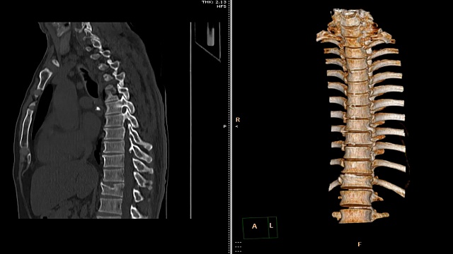 胸椎CT扫描。视频素材