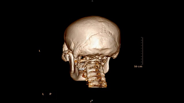 外伤患者颅骨/面骨的CT扫描视频素材