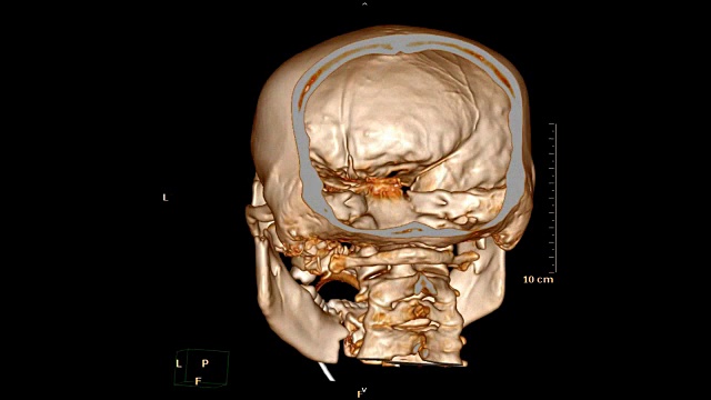 气管内导管损伤颅骨/面骨的CT扫描。视频素材