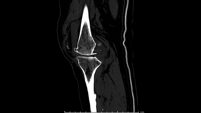 右膝CT扫描。视频素材
