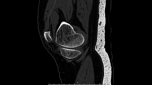 右膝CT扫描三维渲染图像。视频素材