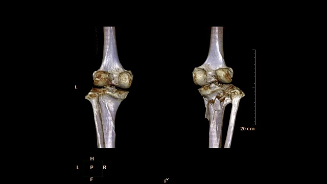 CT扫描双膝三维渲染图像在屏幕上旋转。视频素材