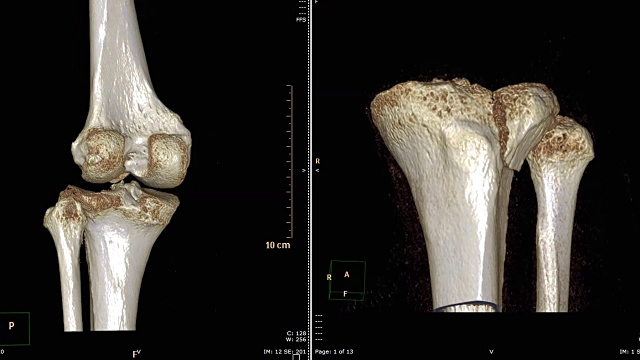 CT扫描右膝关节三维渲染图像在屏幕上旋转。视频素材