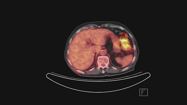 计算机断层扫描(PET/CT)全身轴向视图。视频素材