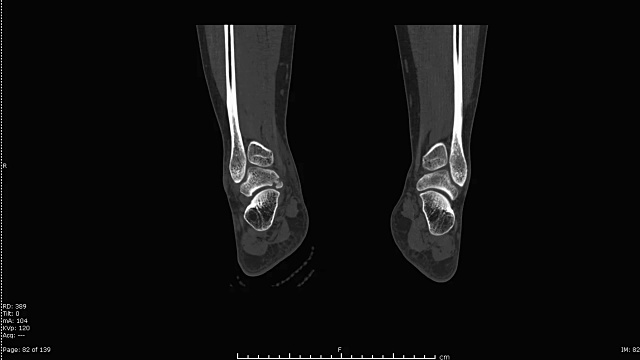 左踝关节CT扫描三维渲染图像。视频素材