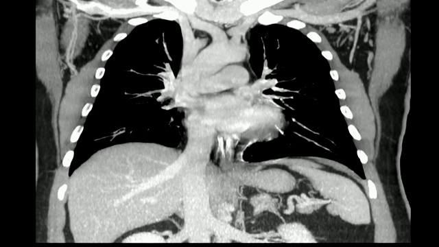 人体胸部CT扫描。视频素材