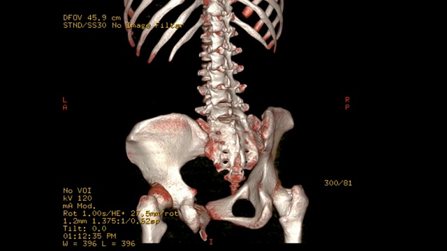 腰椎CT扫描图像渲染图像。在监视器上旋转。视频素材