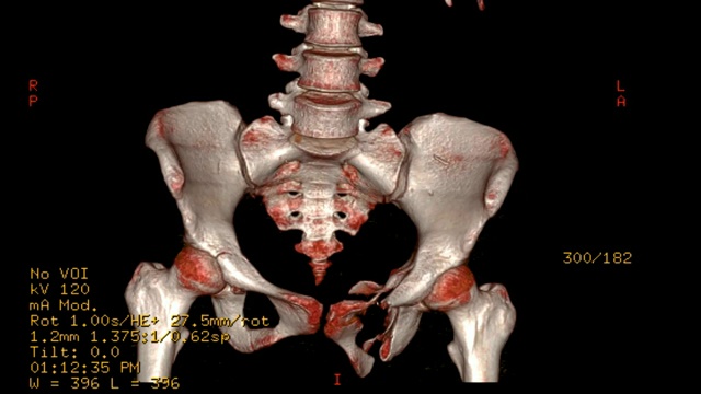 CT扫描图像骨盆骨三维渲染图像。视频素材