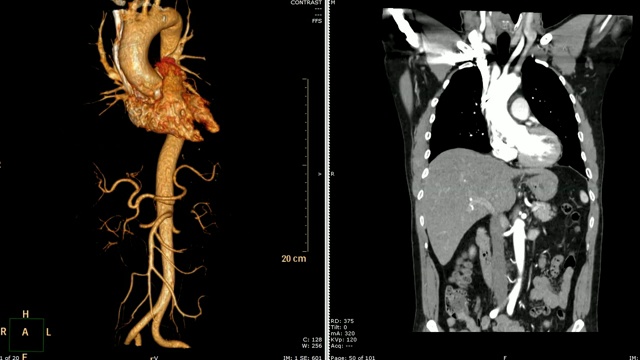 胸主动脉ct血管造影(CTA)三维渲染图像VS冠状面。视频素材