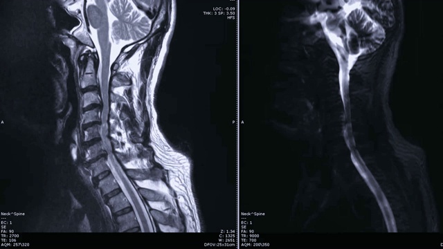 颈椎与脊髓矢状面MRI。视频素材