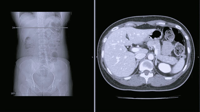 CT扫描/ CT全腹轴位造影剂扫描。阑尾炎的概念。视频素材