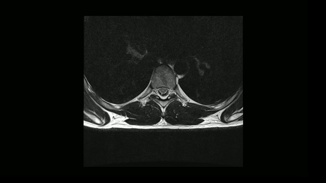 计算机医学断层扫描MRI扫描的胸椎与骨软骨病的男性视频素材
