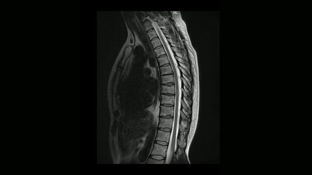 计算机医学断层扫描MRI扫描的胸椎与骨软骨病的男性视频素材
