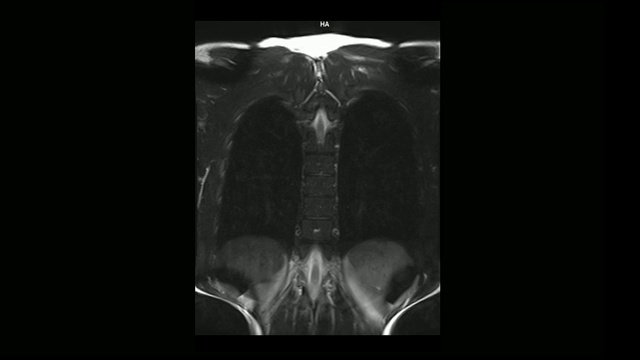 计算机医学断层扫描MRI扫描的胸椎与骨软骨病的男性视频素材