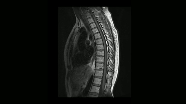 计算机医学断层扫描MRI扫描的胸椎与骨软骨病的男性视频素材