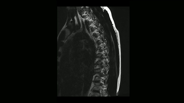 计算机医学断层扫描MRI扫描的胸椎与骨软骨病的男性视频素材