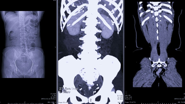 CT尿路造影术。视频素材