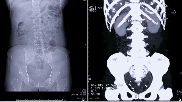泌尿系统CT扫描视频素材