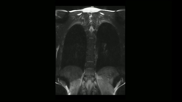 计算机医学断层扫描MRI扫描的胸椎与骨软骨病的男性视频素材