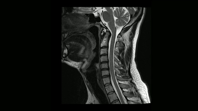 计算机医学断层扫描MRI扫描颈椎与骨软骨病的男性视频素材
