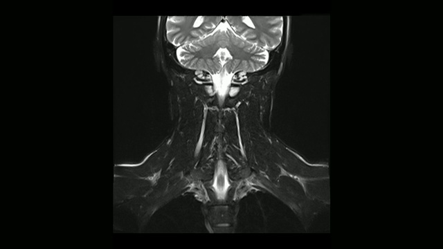 计算机医学断层扫描MRI扫描颈椎与骨软骨病的男性视频素材