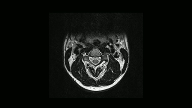 计算机医学断层扫描MRI扫描颈椎与骨软骨病的男性视频素材