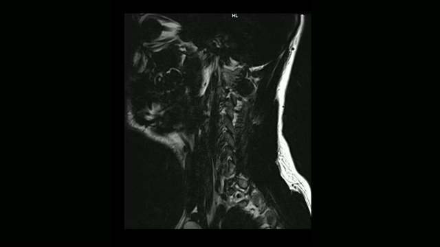 计算机医学断层扫描MRI扫描颈椎与骨软骨病的男性视频素材