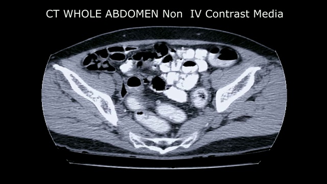 轴位全腹CT。视频素材