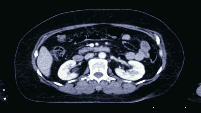 计算机断层扫描(CT)的整个人体。视频素材