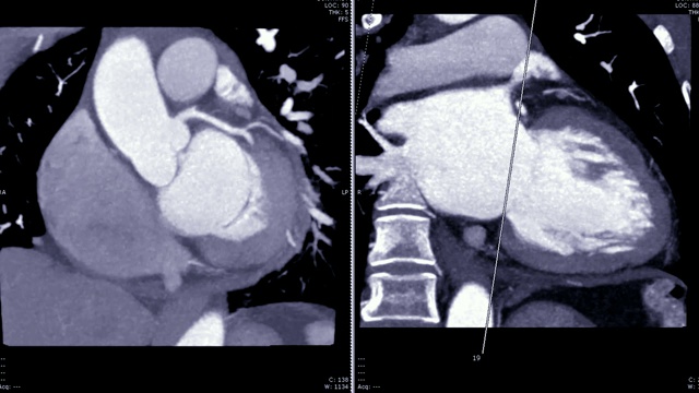 冠状动脉CT血管造影(CTA)冠状斜位面MIP技术显示心脏解剖。视频素材