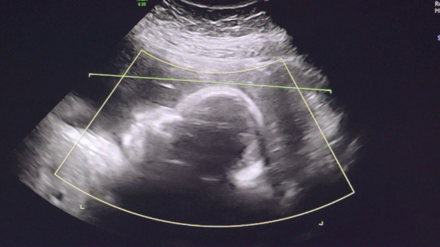 23周胎儿的超声波视频素材