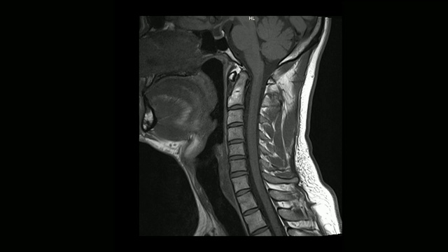 计算机医学断层扫描MRI扫描颈椎与骨软骨病的男性视频素材