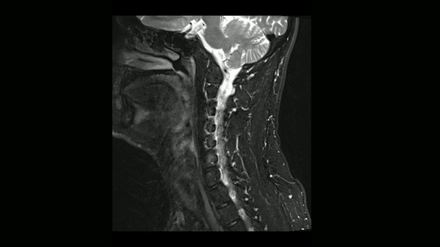 计算机医学断层扫描MRI扫描颈椎与骨软骨病的男性视频素材