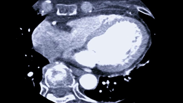 轴位冠状动脉CTA。视频素材