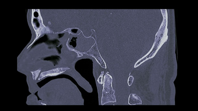 颞骨CT扫描。视频素材