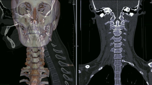 颈椎(C-spine) CT三维渲染图像，矢状面和冠状面。视频素材
