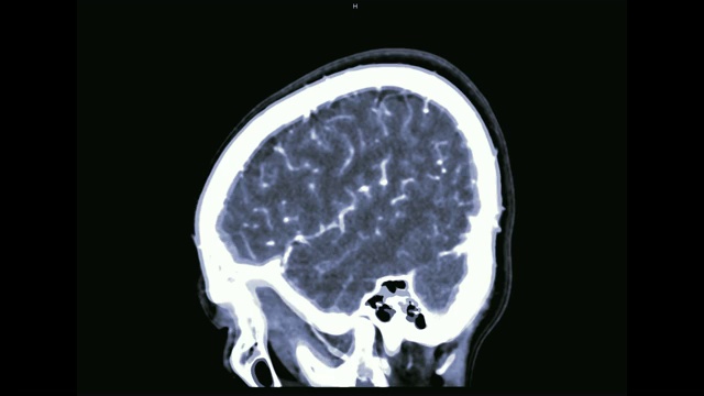 CTA脑或ct血管造影的脑矢状面视图/ 3D渲染图像显示人脑血管。视频素材