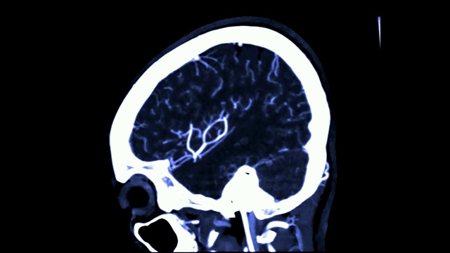 CTA脑或ct血管造影的脑矢状面视图/ 3D渲染图像显示人脑血管。视频素材