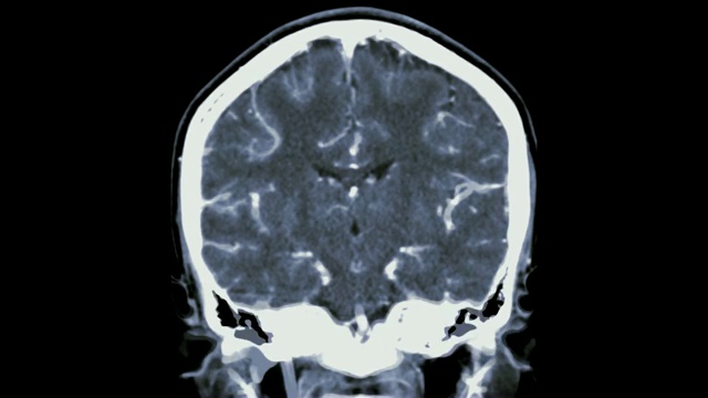 脑CTA或ct冠状面/ 3D渲染图像显示人脑血管。视频素材