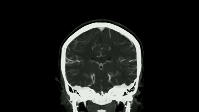 脑CTA或ct冠状面/ 3D渲染图像显示人脑血管。视频素材